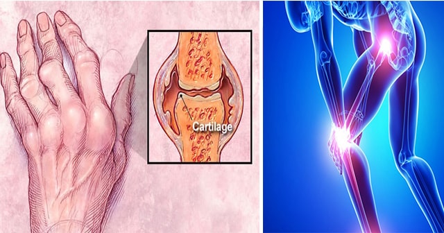Ito ang Tatlong Pagkain na Mas Nagpapalala ng kondisyon ng Arthritis o Rayuma. Kaya dapat itigil na ang Pagkain nito. Alamin dito.