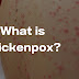 What is Chickenpox? What are the symptoms, How is it prevented, How is it treated?