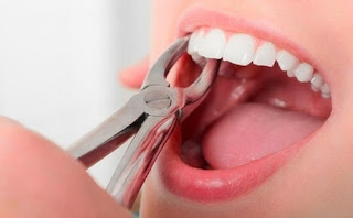 Nhổ răng khi niềng có đau không-2