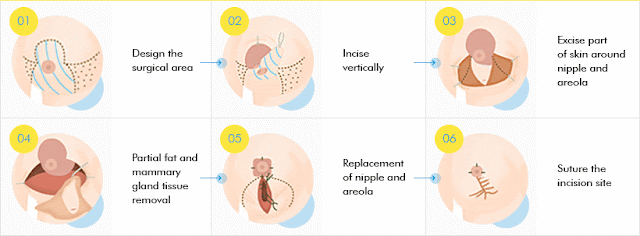 짱이뻐! - Korean Breast Plastic Surgery - Breast Lift