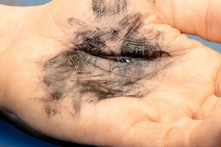   ink poisoning, symptoms of ink poisoning on skin, symptoms of ink poisoning from sharpie, how do you know if you have ink poisoning, ink poisoning from stick and poke, can you die from ink poisoning, can you get ink poisoning from drawing on yourself, ink poisoning sharpie, how to get rid of ink poisoning