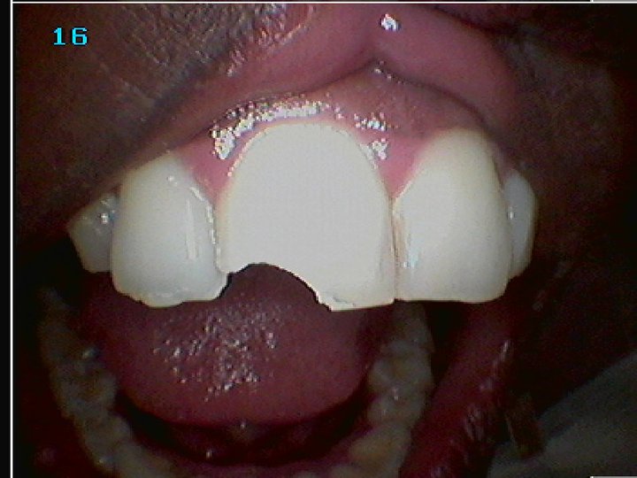 PORUR TOOTH CENTRE DENTAL TRAUMA IN CHILDREN WHAT TO DO?