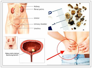 cara menghancurkan batu ginjal tanpa operasi,obat batu ginjal,obat kencing batu,cara mengeluarkan batu ginjal tanpa operasi,cara menghilangkan batu ginjal tanpa operasi