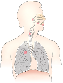 Treatment of COPD