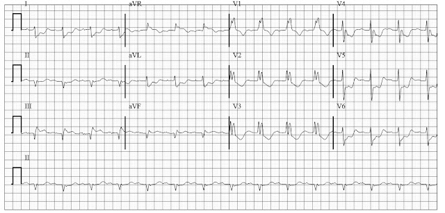 RBBB