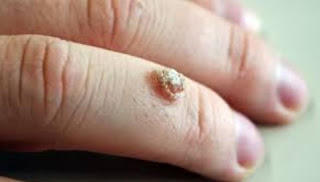 All About Warts