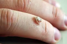 All About Warts