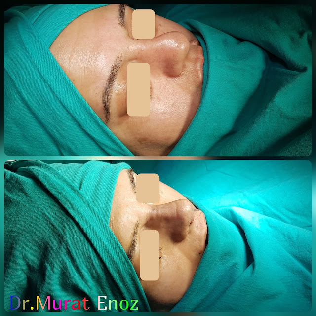 Crooked Nose Aesthetic, Nevus Excision From Lip,caudal septal dislocation, Nose Deformity,Complicated Nose Surgery