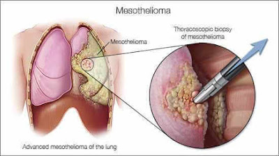 Mesothelioma Prognosis