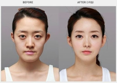 Korea Surgery ~ Kome Yang Suke Sangat Korea