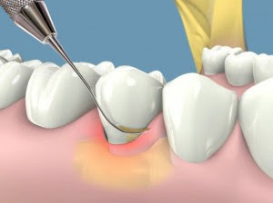 Cách loại bỏ mảng bám chân răng 
