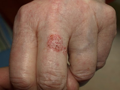 Bowen's Disease Pictures4