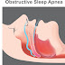Does treatment for sleep apnea in children work?