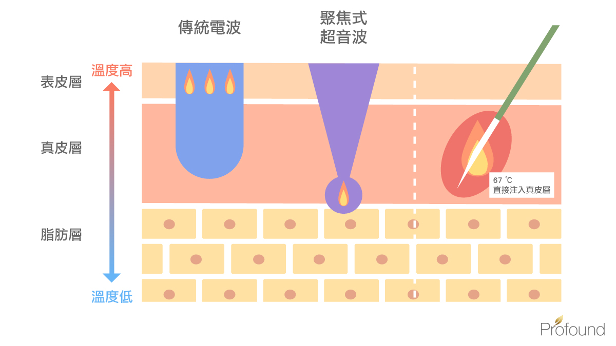 魔方電波魔方電波價格魔方電波肚子價格魔方電波效果魔方電波費用魔方電波ptt魔方電波恢復期魔方電波魔方電波 費用魔方電波 腹部肚皮魔方電波高雄profound魔方電波魔方電波 價位逆齡除皺溫感針除皺消橘皮黃金三秒鐘拉提消脂雙下巴大腿肉產後鬆弛瘦身後鬆弛腹部