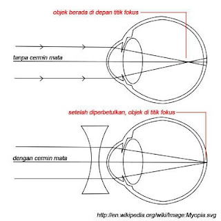 Apa Itu Rabun Jauh