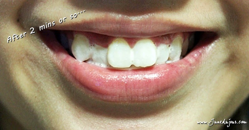 Review: Smile Brilliant Professional LED Teeth Whitening ...