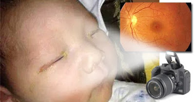 Kisah Nyata Akibat Buruk Selfie!!! Para Orang Tua Wajib Baca, Jangan Sampai Menimpa Anak Anda ! Bayi 3 Bulan Ini Buta Karna Sering Terkena Cahaya Flash Kamera Orang Tuanya Sendiri. Tolong Sebarluaskan Ya.