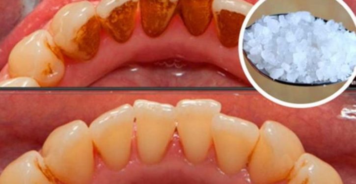 Here Is A Natural Recipe To Naturally Remove Plaque From Teeth!