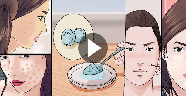 How To Covered Your Acne Within 5 Minutes