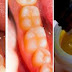 How To Reverse Cavities In a Natural Way And Heal Tooth Decay Using Only This!