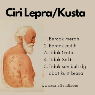 ciri lepra kusta