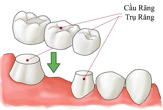 Mất răng hàm số 6 có trồng răng sứ được không ?