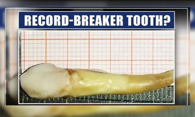 Doctors Extract World’s ‘Longest’ Tooth in Central Kashmir