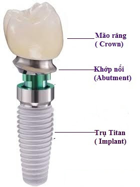 Cấu tạo của 1 chiếc răng implant