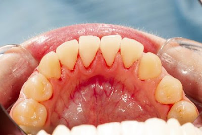  Nhổ răng bị viêm chân răng lâu ngày
