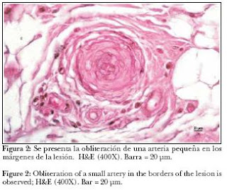 miositis osificante 