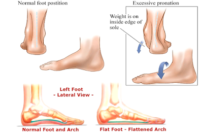 วิธีรักษา อาการเท้าแบน ปวดข้อเท้า ปวดหัวเข่า ปวดสะโพก ปวดหลัง