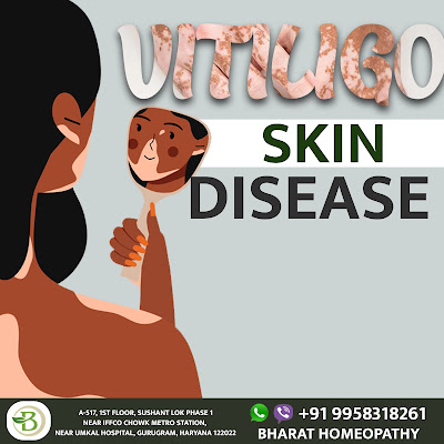 vitiligo treatment by bharat Homeopathy