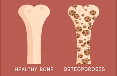osteoporosis pengobatan