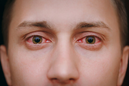 Eye Flu: मानसून में तेजी से बढ़ रहा Eye Flu का खतरा, जानें इसके लक्षण और इससे बचाव के तरीके