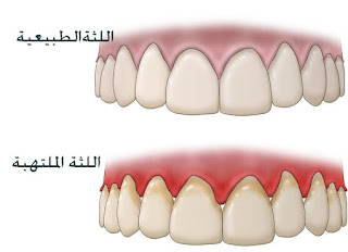 علاج التهاب اللثة وانتفاخها بالاعشاب