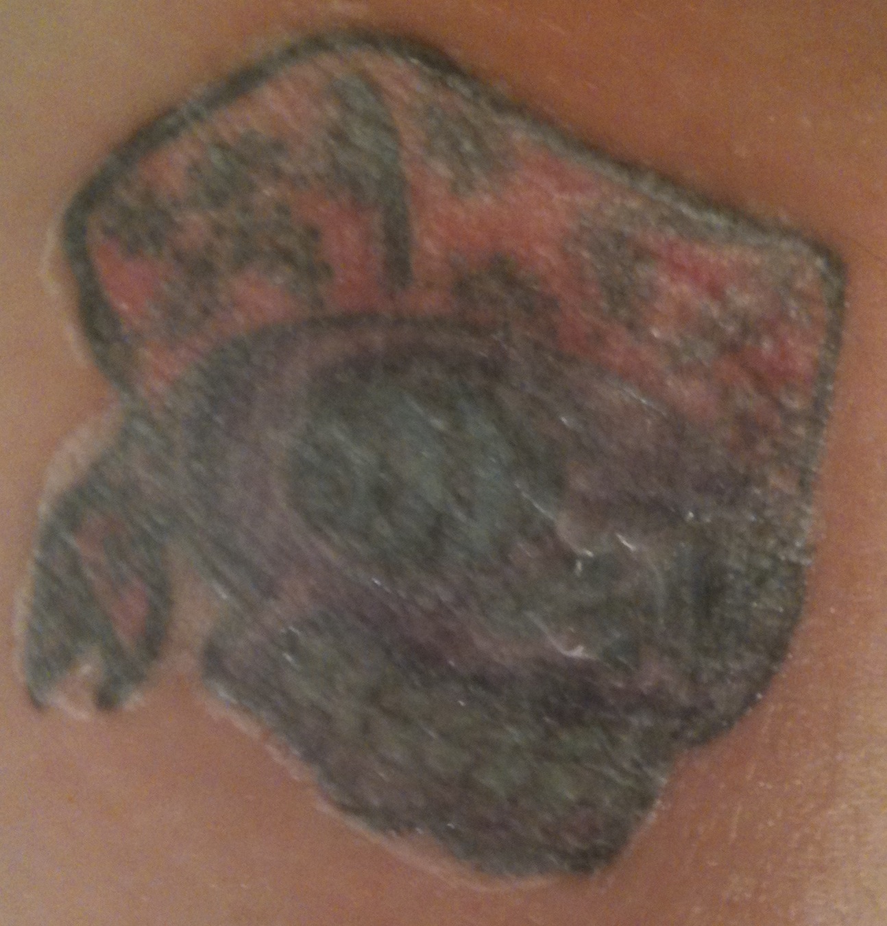 Trichloroacetic Acid (TCA) Tattoo Removal: June 2011