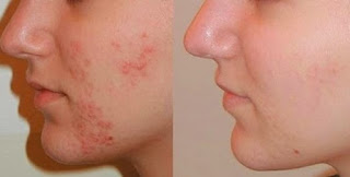 Como Eliminar El Acne