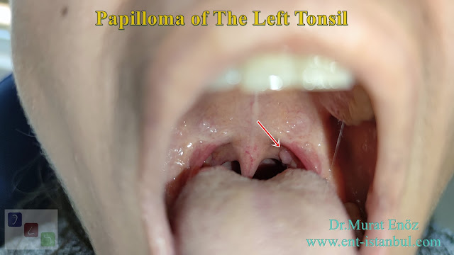 tonsil papilloma