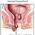 obat benjolan di anus ampuh tanpa operasi