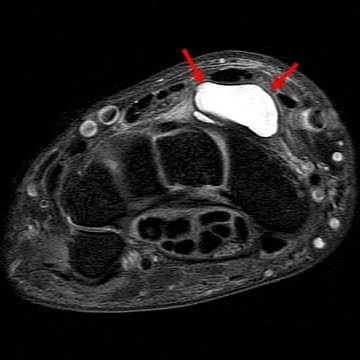 ax+t2 Ganglionic Cyst