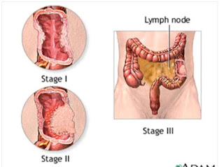 Cara Mengobati Kanker Usus