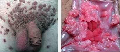 Media Penularan Virus Hepatitis B