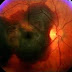 Prometedor tratamiento contra la degeneración macular asociada a la edad