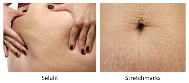 perbedaan antara selulit dengan stretch marks