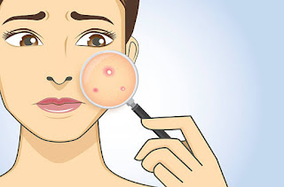 Types of Acne, acne, health, beauty