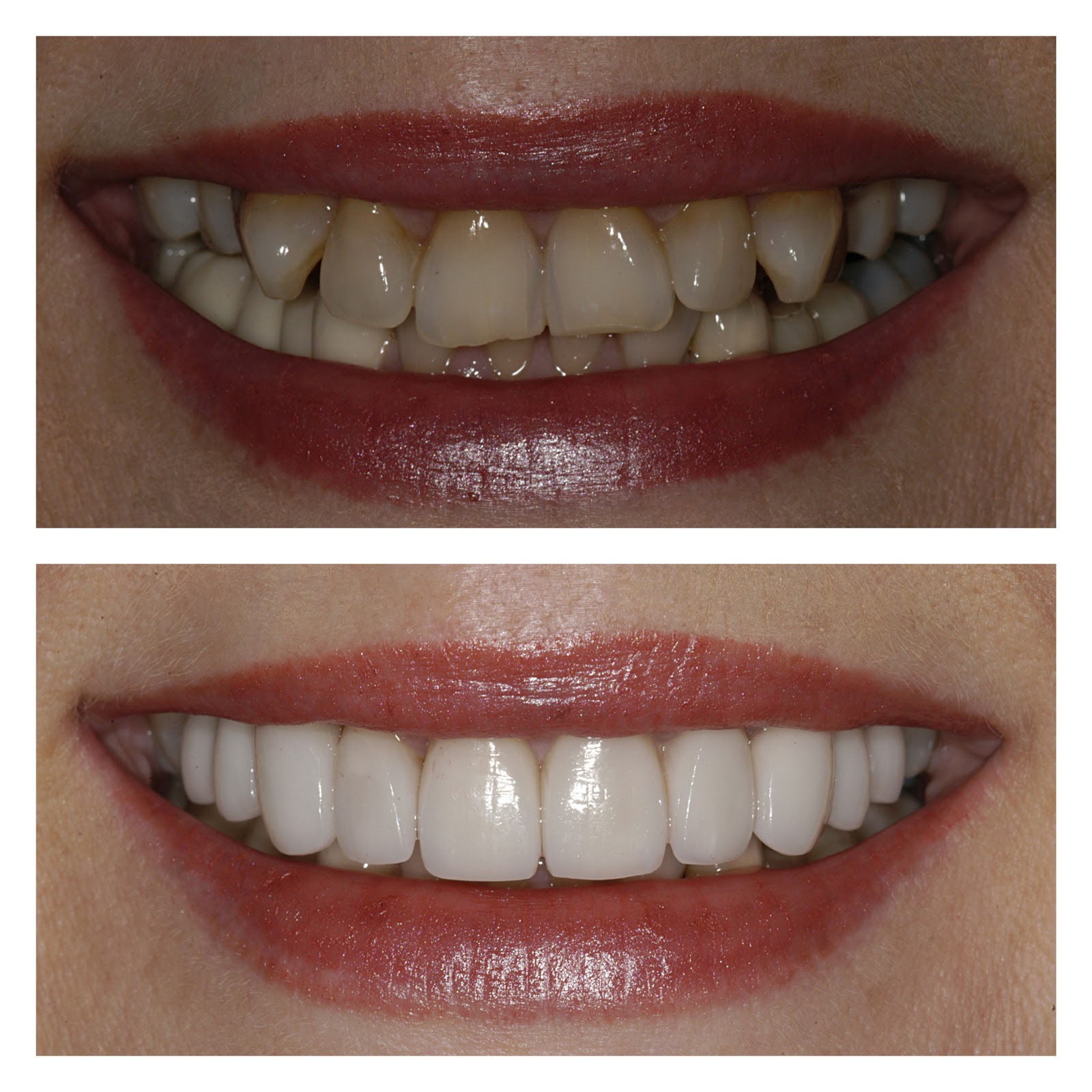 Home Remedies For Teeth Whitening Whitening Teeth Remedies | Personal