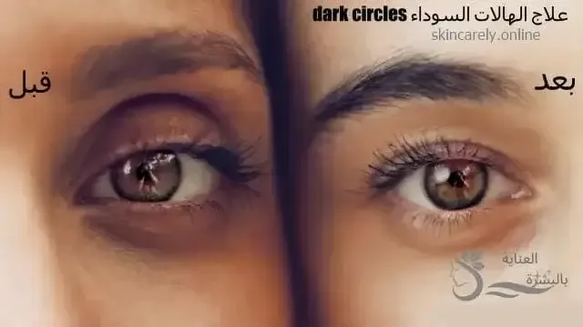 علاج الهالات السوداء dark circles