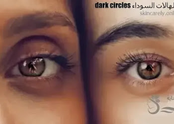 كيفية علاج الهالات السوداء dark circles الداكنة