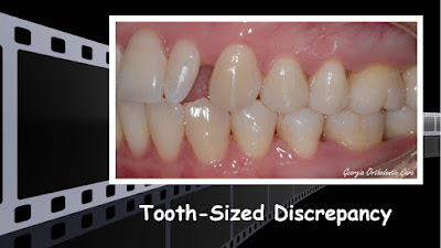 peg lateral, tooth-sized discrepancy, composite restoration, tooth colored restoration, Orthodontics, orthodontists, Clear, Invisible, Braces, Invisalign, underbite,class III, face mask, non-surgery, non-extraction, crossbite, overbite, class II, crooked, spaced, crowding, teeth, severe, jaw alignment, cosmetics, implants, children, dentists, dentistry, friendly, adults, children, family, Lawrenceville, Norcross, Buford, Hamilton Mill, Dacula, Auburn, Sugar Hill, Sugar Loaf, Doraville, Chamblee, Stone Mountain, Decatur, Collins Hill, Snellville, Suwanee, Grayson, Lilburn, Duluth, Cumming, Alpharetta, Marietta, Dekalb, Gwinnett, County, Atlanta, North Georgia, GA, Georgia, 30043, 30093, affordable, Vietnamese, Spanish, weekend, Saturday, appointments, Dr. Quang Nguyen, Georgia Orthodontic Care, Nguyen Orthodontics.