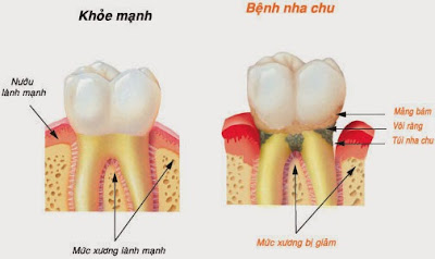 Cạo vôi răng dưới nướu có chảy máu không? 1